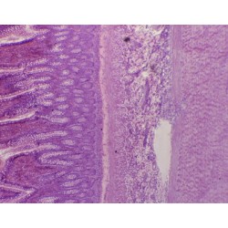 INTESTINO GRUESO, S.T.  