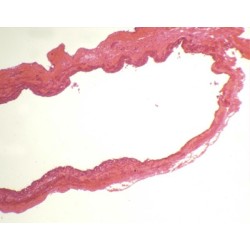 VENA DE RANA, S.T. 